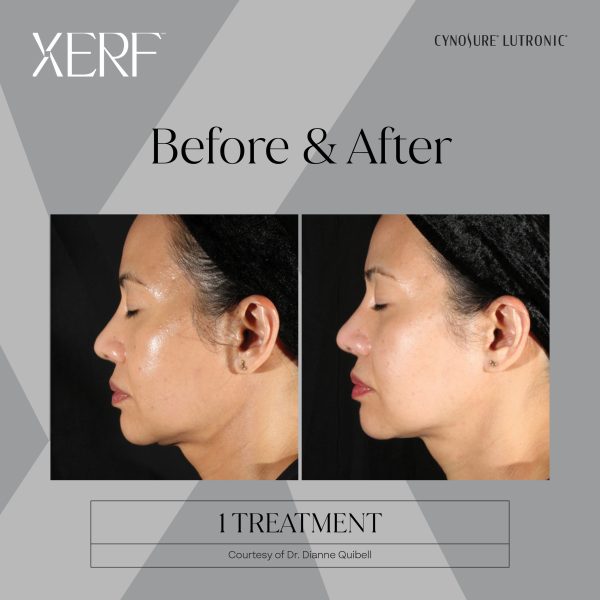 XERF After Weight Loss in Mesa & Scottsdale AZ | XERF Treatment Near Me | New Result Medical Weight Loss XERF After Weight Loss in Mesa & Scottsdale AZ | XERF Treatment Near Me | New Result Medical Weight Loss